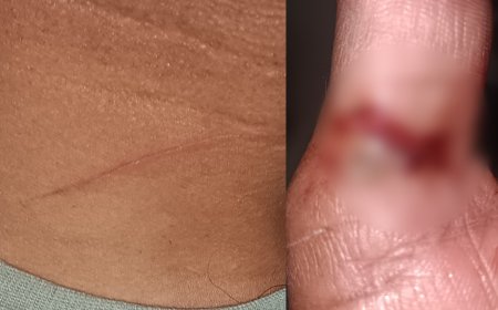 गळ्यावरचा घाव बोटांवर गेला,इंदापुरात दुचाकीस्वार थोडक्यात बचावला ! चायनीज मांजा विक्रेत्यांवर कारवाई कधी ? 